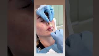 See the Magic of Filler Rhinoplasty at EDEN AESTHETICS [upl. by Aremaj]