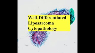 Lipomatous Tumor Cytopathology Interesting Case Conference [upl. by Zed890]