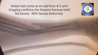 Fracture both bones forearm  PAEDIATRIC fractures  Closed reduction forearm fractures  Adamya H V [upl. by Enileoj123]