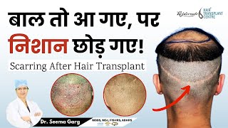 Hair Transplant Scars  Scarring After Hair Transplant  बाल तो आ गए पर निशान छोड़ गए [upl. by Nahtanha790]