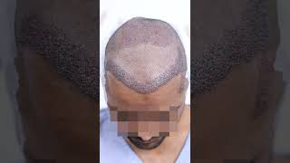 Failed Hairline Hair Transplant Correction [upl. by Northey]