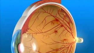 Understanding Proliferative Diabetic Retinopathy [upl. by Rochester214]