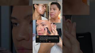 Banish 20 Microneedling Update acne acnejourney microneedling dermastamp banishacnescars [upl. by Nosned18]