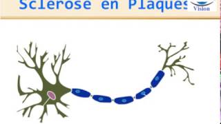 Sclérose en Plaques Physiopathologie Symptomes Diagnostic IRM traitement [upl. by Hnid]