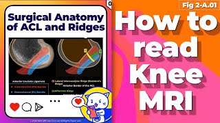 Fig 2A01 Surgical Anatomy of ACL and Associated Ridges [upl. by Laemsi833]