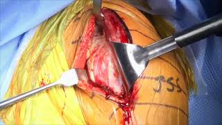 Anatomic Shoulder Arthroplasty for Primary Glenohumeral Osteoarthritis [upl. by Fairweather419]