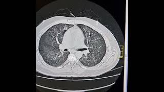 Pneumocystis jirovici pneumonia [upl. by Aicilla]