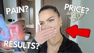 I got veneers in Dubai no teeth shaving before  after VLOG [upl. by Suilenrac]