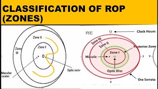 ZONES IN RETINOPATHY OF PREMATURITY  ROP [upl. by Akimit104]