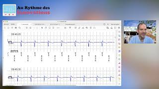 Apprendre à lire un ECG à partir d’un tracé de moniteur cardiaque implantable Aspects techniques [upl. by Ariaek864]