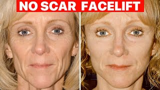 Scarless Facelift  Plastic Surgeon Explains [upl. by Ykroc512]