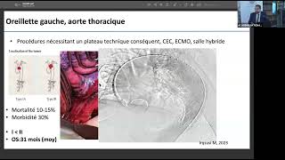 06 Résections oncologiques thoraciques étendues [upl. by Nylave]