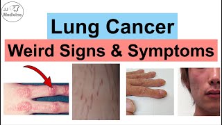 Lung Cancer Weird Signs and Symptoms  Paraneoplastic Syndromes of Lung Cancer [upl. by Aileno]