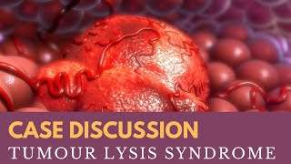 Case Discussion  Tumour Lysis Syndrome [upl. by Creighton]