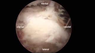 Endoscopic decompression for lumbar stenosis by UBE [upl. by Oslec417]