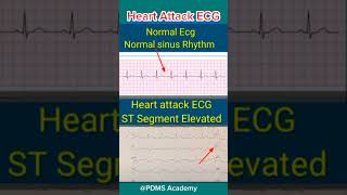 ECG changes During Heart Attack medicine ecg [upl. by Esinert]