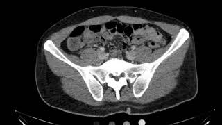 Fournier gangrene CT Axial [upl. by Illah]