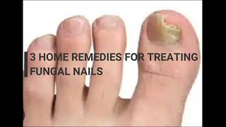 3 home remedies for treating fungal nails infection  whats eating my nails [upl. by Salohci]