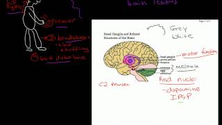 Parkinsons Dementia [upl. by Hutchison]