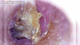 Ear Wax Removal 140 Earwax Is Wet On The Outside And Dry On The Inside  Ear Cleaning ASMR [upl. by Ihsar]