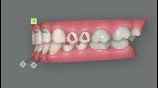 Invisalign Clincheck simulation Correction of deep bite and traumatic occlusion Delicate case [upl. by Humbert195]