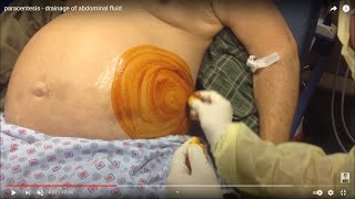 Ascitic fluid tapping technique ASCITIC TAP PROCEDUREPERITONEAL FLUID DRAINAGEABDOMINAL FLUID [upl. by Oirretna]