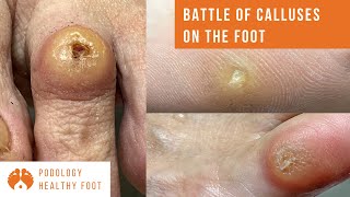 BATTLE OF CALLUSES ON THE FOOT 3 calluses removal on different parts of the foot ASMR podologia [upl. by Iroj]