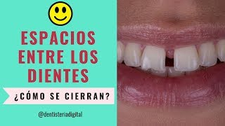 Espacios entre los dientes ¿Cómo cerrarlos Ortodoncia o Diseño de Sonrisa [upl. by Jillane]