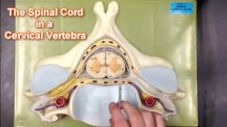 Spinal Cord Transection in Cervical Vertebra [upl. by Ehcar]