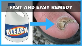 How to Get Rid of Toenail Fungus with Bleach  Toe Fungus Journey [upl. by Gnouhp]