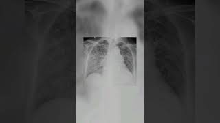 CXR OF TUBERCULOSIS PATIENT MILIARY TB  COMMENT THE SYMPTOMS OF MILIARY TB  MEDICOS  DOCTOR [upl. by Auguste]