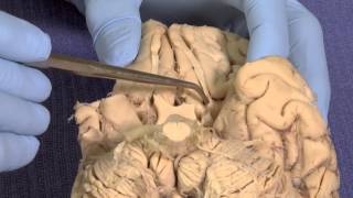 Olfactory Neuroanatomy Video Lab  Brain Dissections [upl. by Higley327]