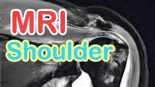 MRI For Shoulder [upl. by Lempres]