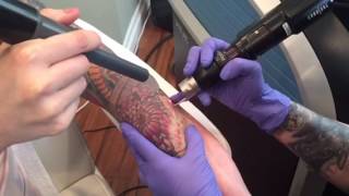 PicoSure Tattoo Removal  Color Ink on Arm [upl. by Brittany]