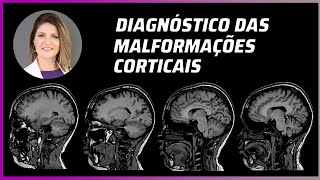 MALFORMAÃ‡Ã•ES CORTICAIS  EXAME DE RESSONÃ‚NCIA E DIAGNÃ“STICO [upl. by Palua]