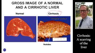 CIRRHOSIS LIVER SCARRING by Dr Robert Gish [upl. by Symon]