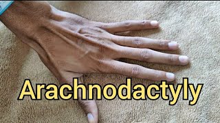 Arachnodactyly in Marfan Syndrome [upl. by Notxam]