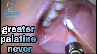 greater palatine nerve injection  شرح نظرى و عملى [upl. by Auston]