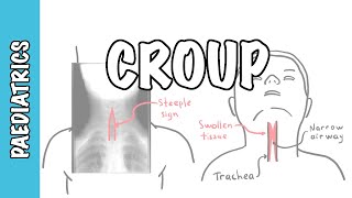 What is Croup larynotracheobronchitis  symptoms pathophysiology investigations treatment [upl. by Caritta274]