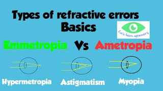 Emmetropia amp Ametropia Different types of refractive errorsMyopia HypermetropiaAstigmatism [upl. by Tennos]