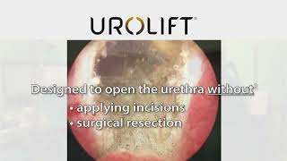 UroLift™ System Treatment [upl. by Akedijn69]