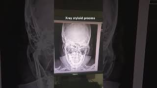 Styloid process towns viewxray styloidskullskull xrayskull anatomy [upl. by Morentz525]