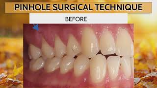 Dr Nemeths Success in Reversing Gum Recession 🦷 🔄 [upl. by Attennaj]