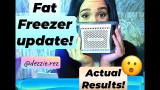 How to Use MYCHWAY Fat Freeze Bodysculpting System at Home 7202C [upl. by Sallie80]