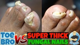 Trimming of Super Thick Fungal Nails FULL TREATMENT [upl. by Ardnohsed]