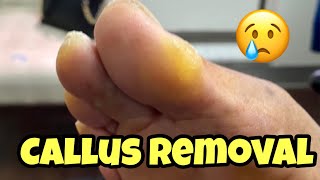 EXTREMELY SATISFYING CALLUS REMOVAL FROM THE FOOT [upl. by Assele]