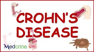 pathophysiology of crohns disease [upl. by Aicsila698]