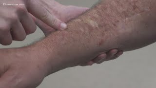 Skin Cancer How to spot melanoma warning signs [upl. by Warram]