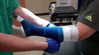 Application of a Thumb Spica Cast [upl. by Aizahs913]