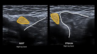 Sportsmans Hernia [upl. by Nowd]